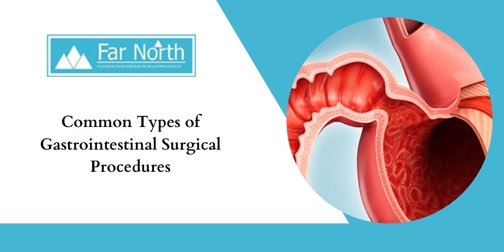 Common Types of Gastrointestinal Surgical Procedures