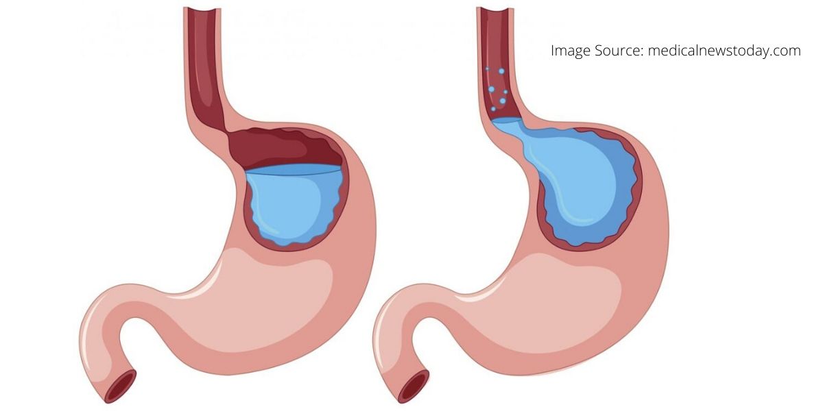 GERD (Gastroesophageal Reflux Disease): Symptoms, Causes, Treatments, Remedies for Relief