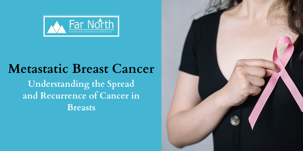 Metastatic Breast Cancer: Understanding the Spread and Recurrence of Cancer in Breasts