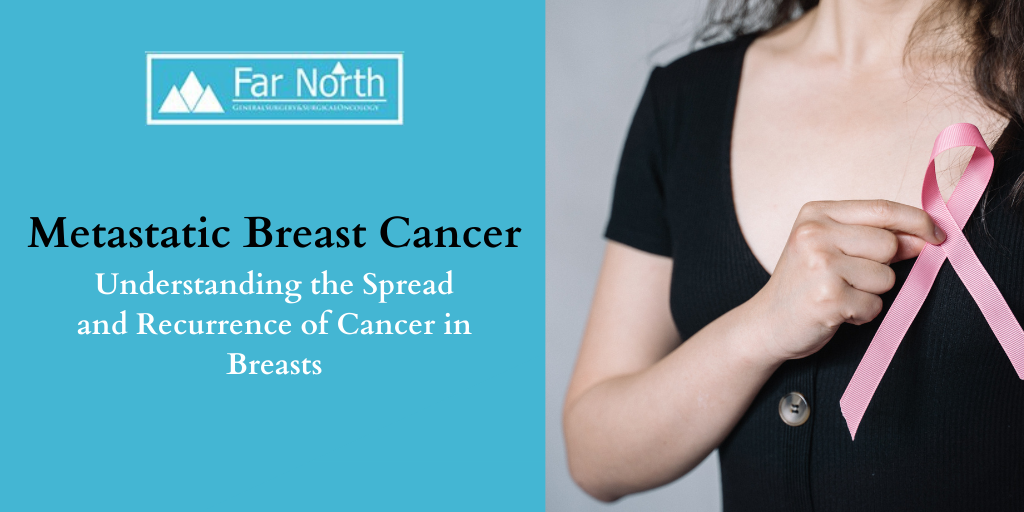 Metastatic Breast Cancer Understanding The Spread And Recurrence Of Cancer In Breasts