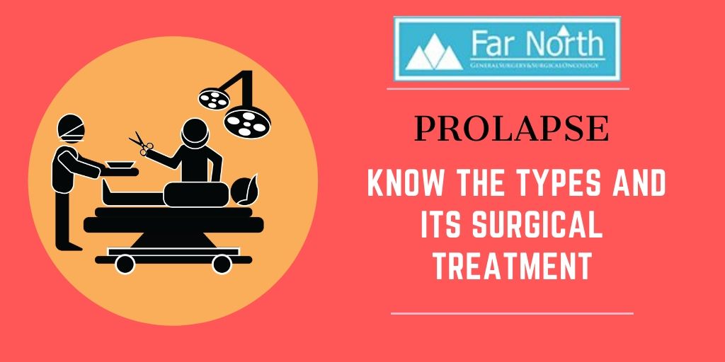 Prolapse: Know the Types and Its Surgical Treatment