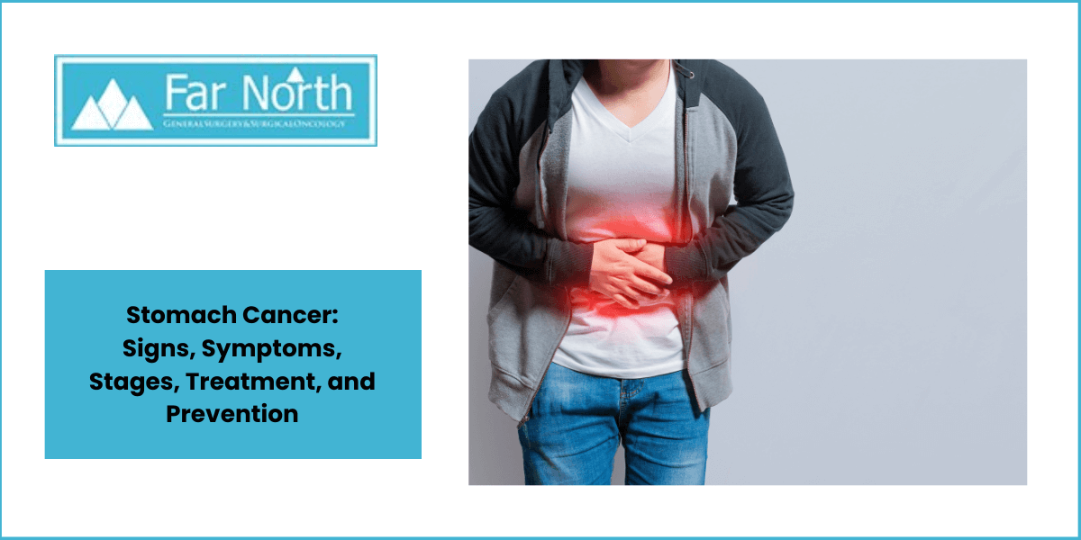 Stomach Cancer: Signs, Symptoms, Stages, Treatment, and Prevention