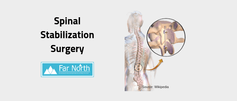 Spinal Stabilization Surgery: What Does It Involve?